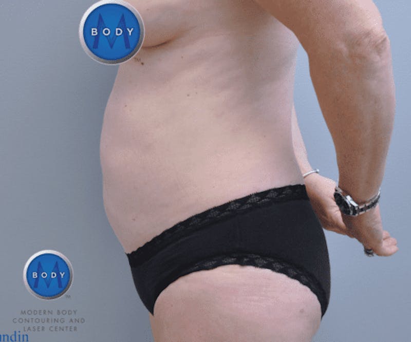 Liposuction Before & After Gallery - Patient 211876581 - Image 6