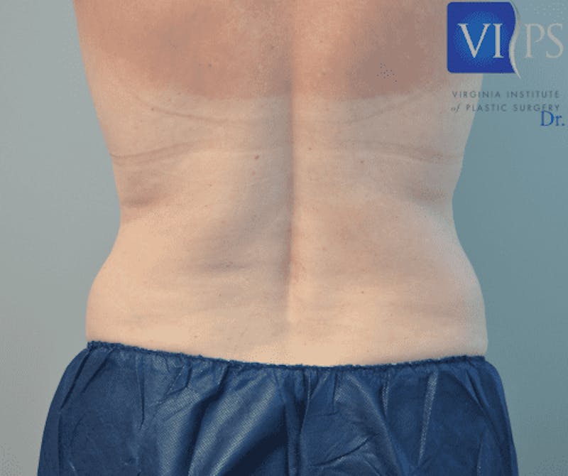 Liposuction Before & After Gallery - Patient 211876581 - Image 7