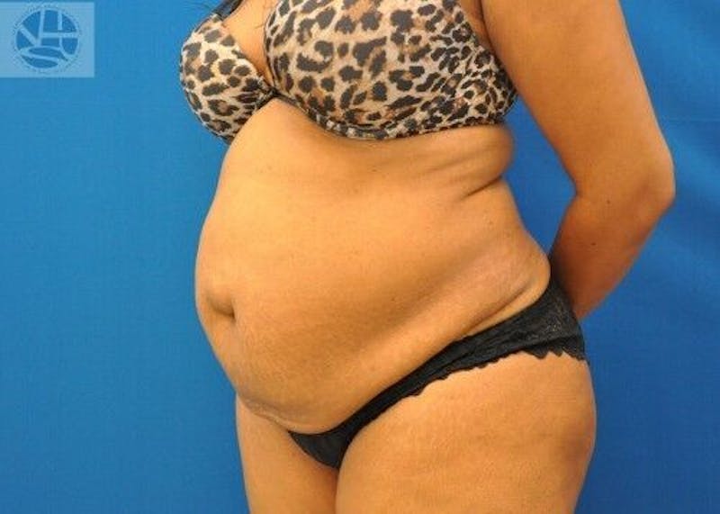 Tummy Tuck Before & After Gallery - Patient 55345363 - Image 5