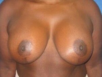 Breast Lift Before & After Gallery - Patient 55345361 - Image 2