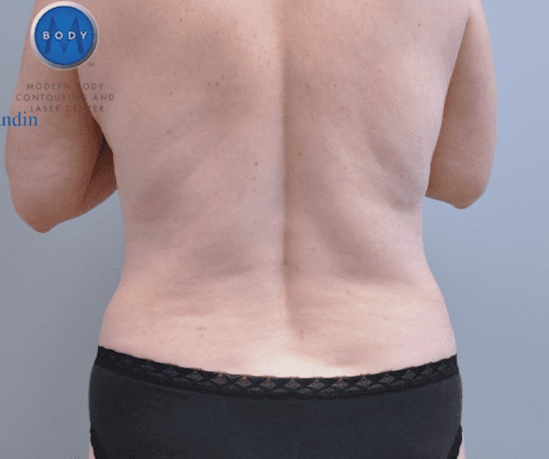Liposuction Before & After Gallery - Patient 211876581 - Image 8