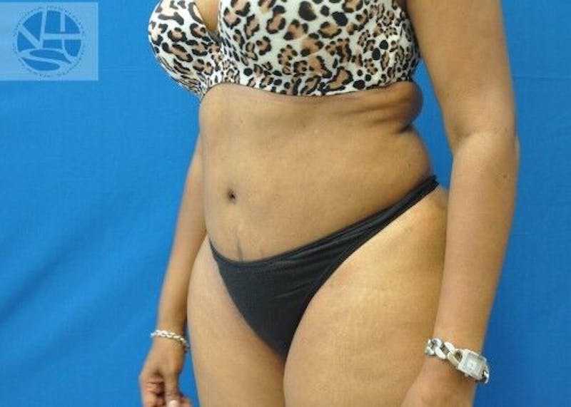 Tummy Tuck Before & After Gallery - Patient 55345363 - Image 6