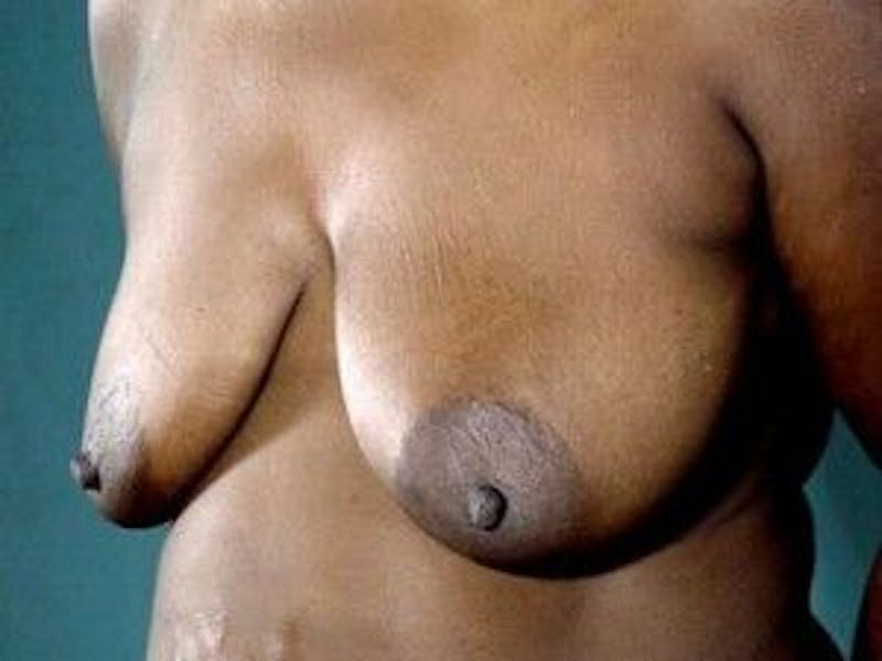 Breast Lift Before & After Gallery - Patient 55345361 - Image 3