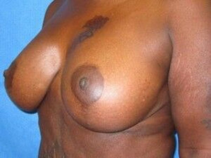 Breast Lift Before & After Gallery - Patient 55345361 - Image 4