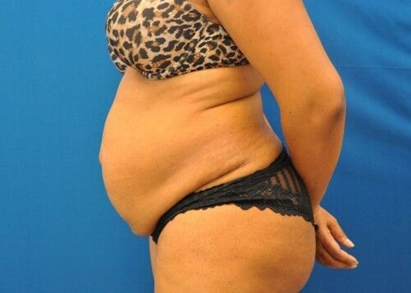 Tummy Tuck Before & After Gallery - Patient 55345363 - Image 7