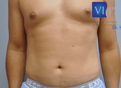 Liposuction Gallery - Patient 55345368 - Image 1