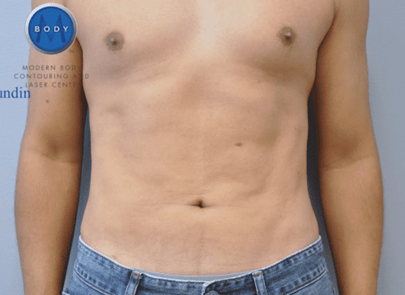 Renuvion J-Plasma Before & After Gallery - Patient 211876534 - Image 2