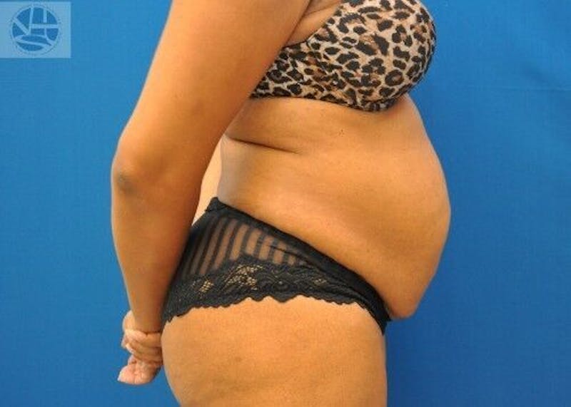 Tummy Tuck Before & After Gallery - Patient 55345363 - Image 9