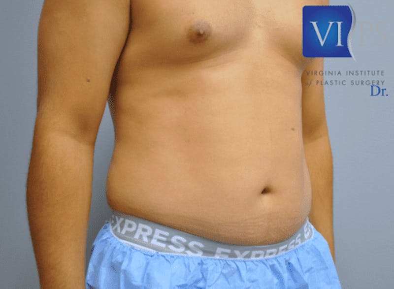 Liposuction Before & After Gallery - Patient 211876585 - Image 3