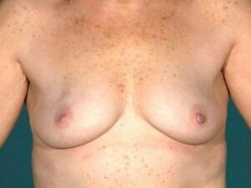 Breast Lift Before & After Gallery - Patient 55345367 - Image 1