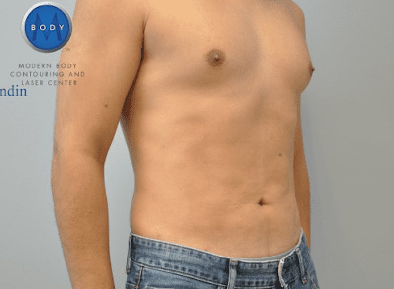 Renuvion J-Plasma Before & After Gallery - Patient 211876534 - Image 4