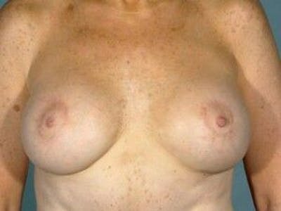 Breast Lift Before & After Gallery - Patient 55345367 - Image 2
