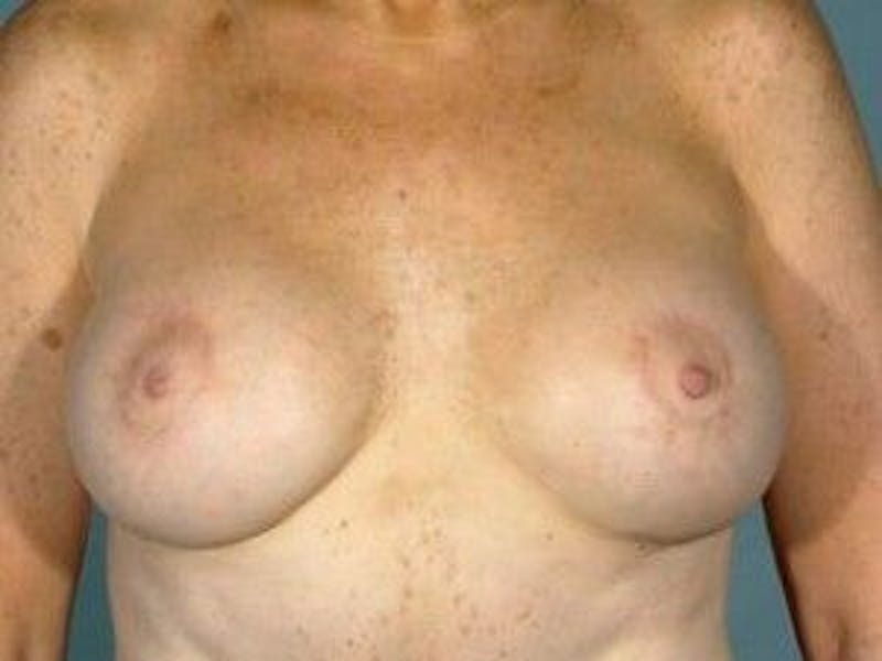Breast Lift Before & After Gallery - Patient 55345367 - Image 2