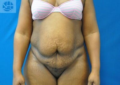 Tummy Tuck Before & After Gallery - Patient 55345373 - Image 1