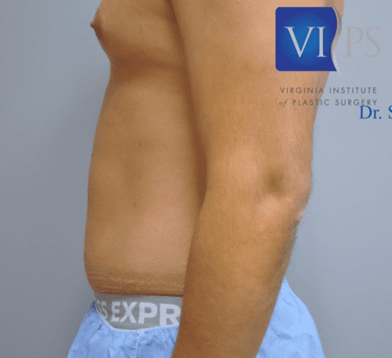Liposuction Before & After Gallery - Patient 211876585 - Image 5