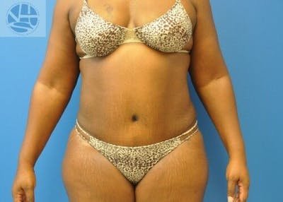 Tummy Tuck Before & After Gallery - Patient 55345373 - Image 2