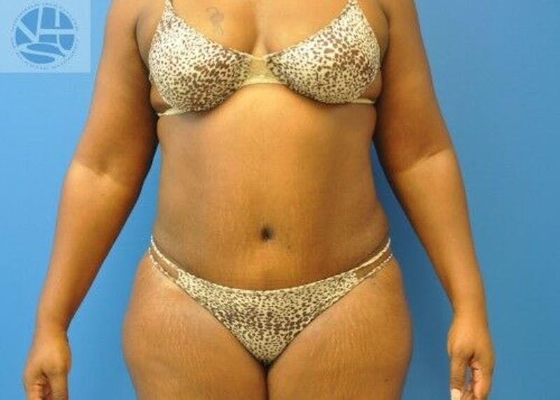 Plus Size Tummy Tuck Before & After Gallery - Patient 702087 - Image 2