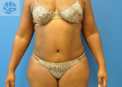 Plus Size Tummy Tuck Before & After Gallery - Patient 702087 - Image 2