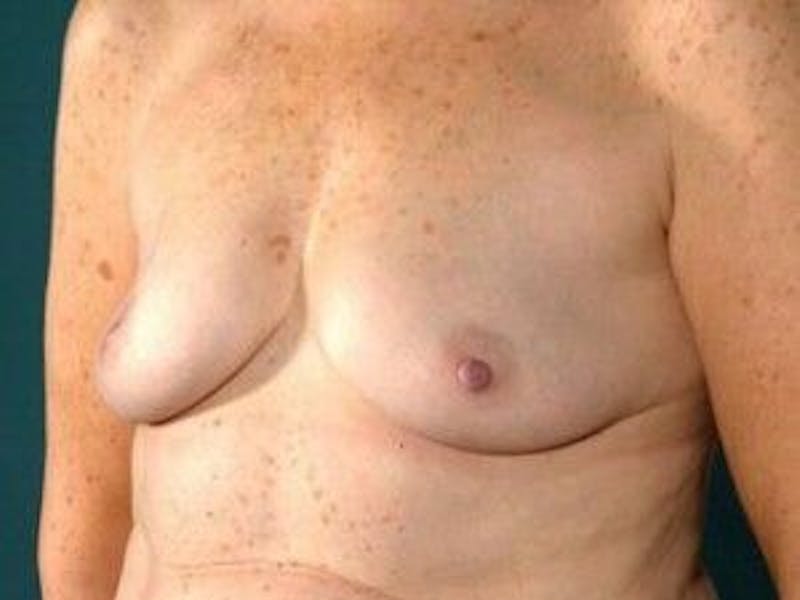Breast Lift Before & After Gallery - Patient 55345367 - Image 3