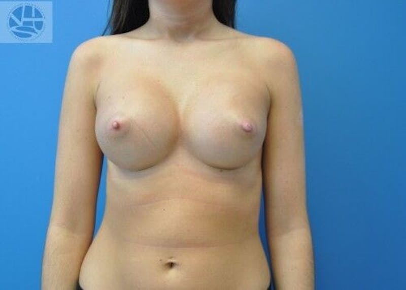 Breast Augmentation Before & After Gallery - Patient 55345370 - Image 2
