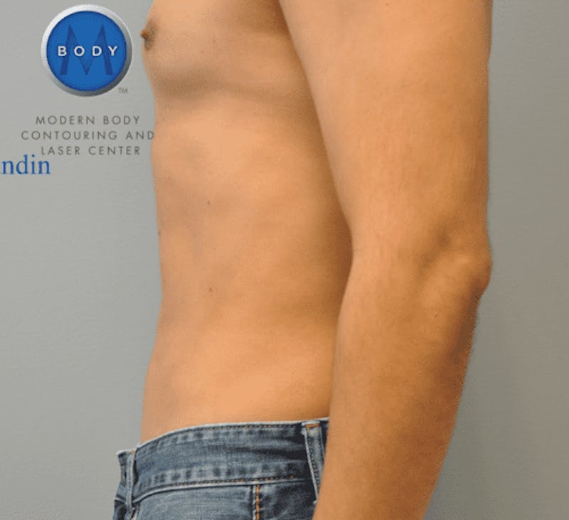 Renuvion J-Plasma Before & After Gallery - Patient 211876534 - Image 6