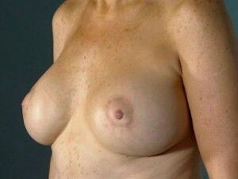 Breast Lift Before & After Gallery - Patient 55345367 - Image 4