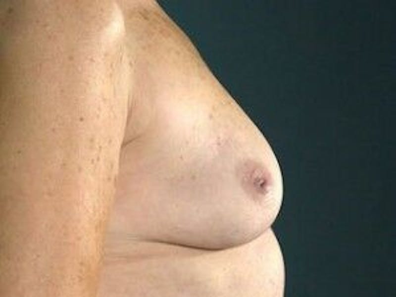 Breast Lift Before & After Gallery - Patient 55345367 - Image 5