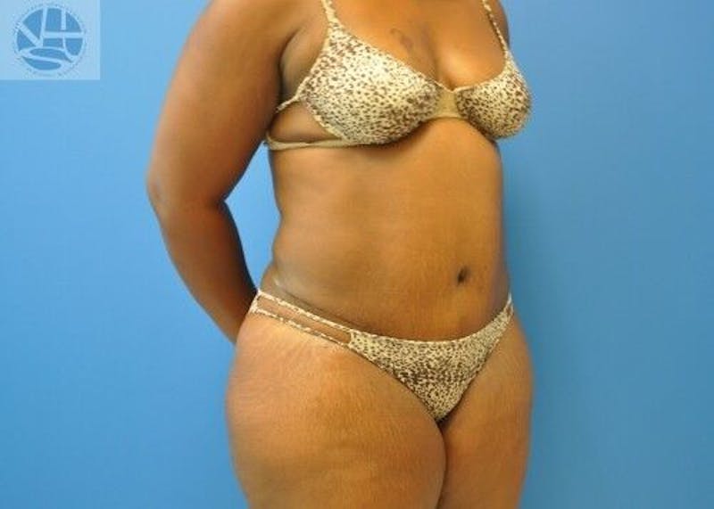 Plus Size Tummy Tuck Before & After Gallery - Patient 702087 - Image 4