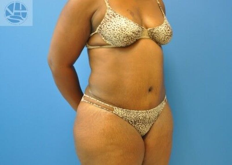 Tummy Tuck Before & After Gallery - Patient 55345373 - Image 4