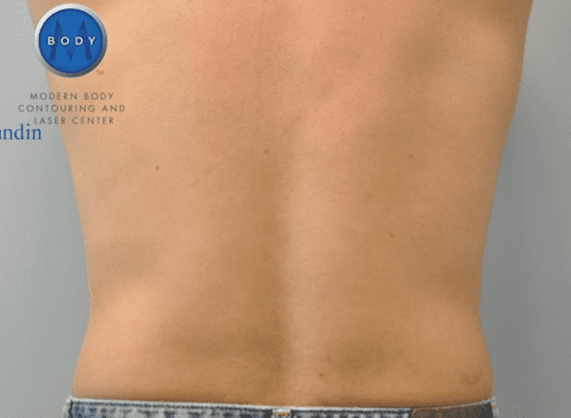Liposuction Before & After Gallery - Patient 211876585 - Image 8