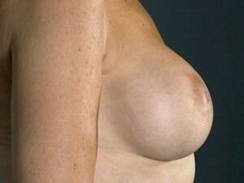 Breast Lift Before & After Gallery - Patient 55345367 - Image 6