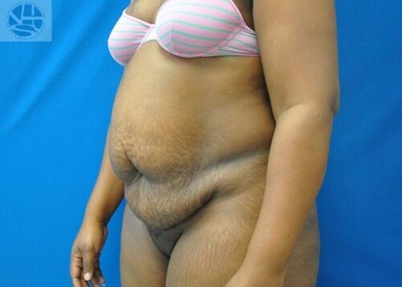 Tummy Tuck Before & After Gallery - Patient 55345373 - Image 5