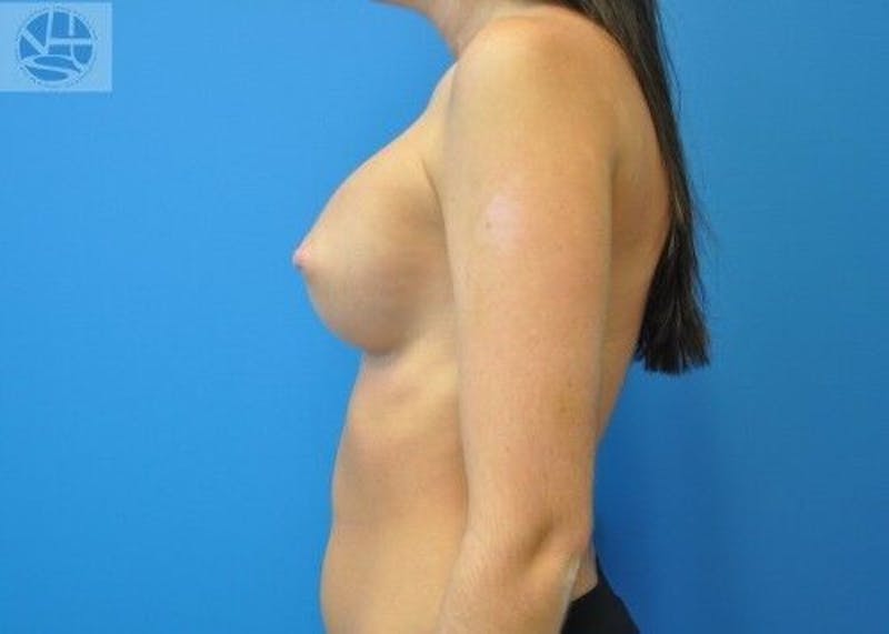 Breast Augmentation Before & After Gallery - Patient 55345370 - Image 6