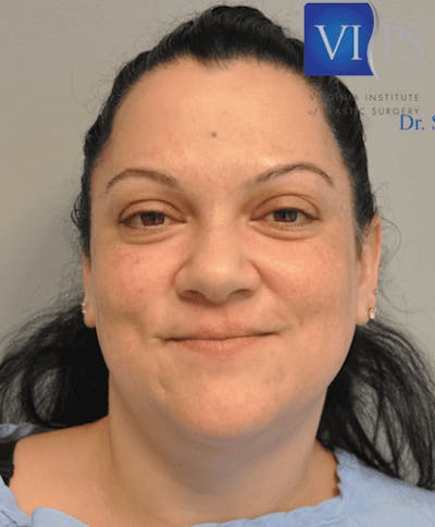 Renuvion J-Plasma Before & After Gallery - Patient 211876555 - Image 1