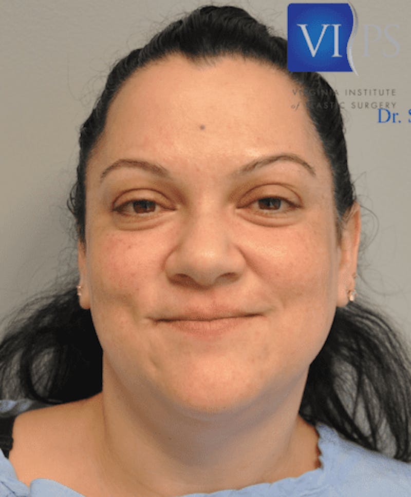 Liposuction Before & After Gallery - Patient 55345375 - Image 1