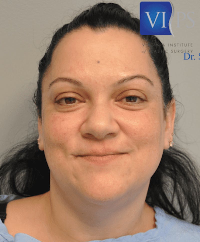 Renuvion J-Plasma Before & After Gallery - Patient 211876555 - Image 1