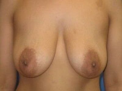 Breast Lift Before & After Gallery - Patient 55345374 - Image 1
