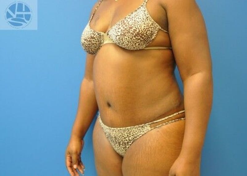 Tummy Tuck Before & After Gallery - Patient 55345373 - Image 6
