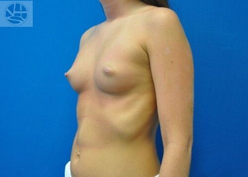Breast Augmentation Before & After Gallery - Patient 55345370 - Image 7