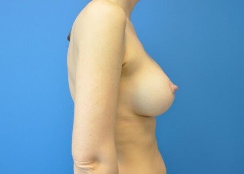 Breast Augmentation with Lift Gallery - Patient 55345371 - Image 8