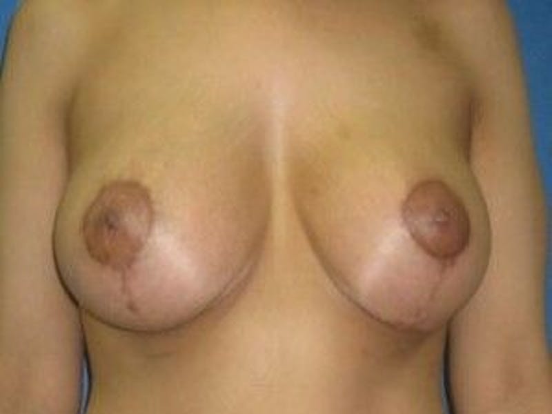 Breast Lift Gallery - Patient 55345374 - Image 2