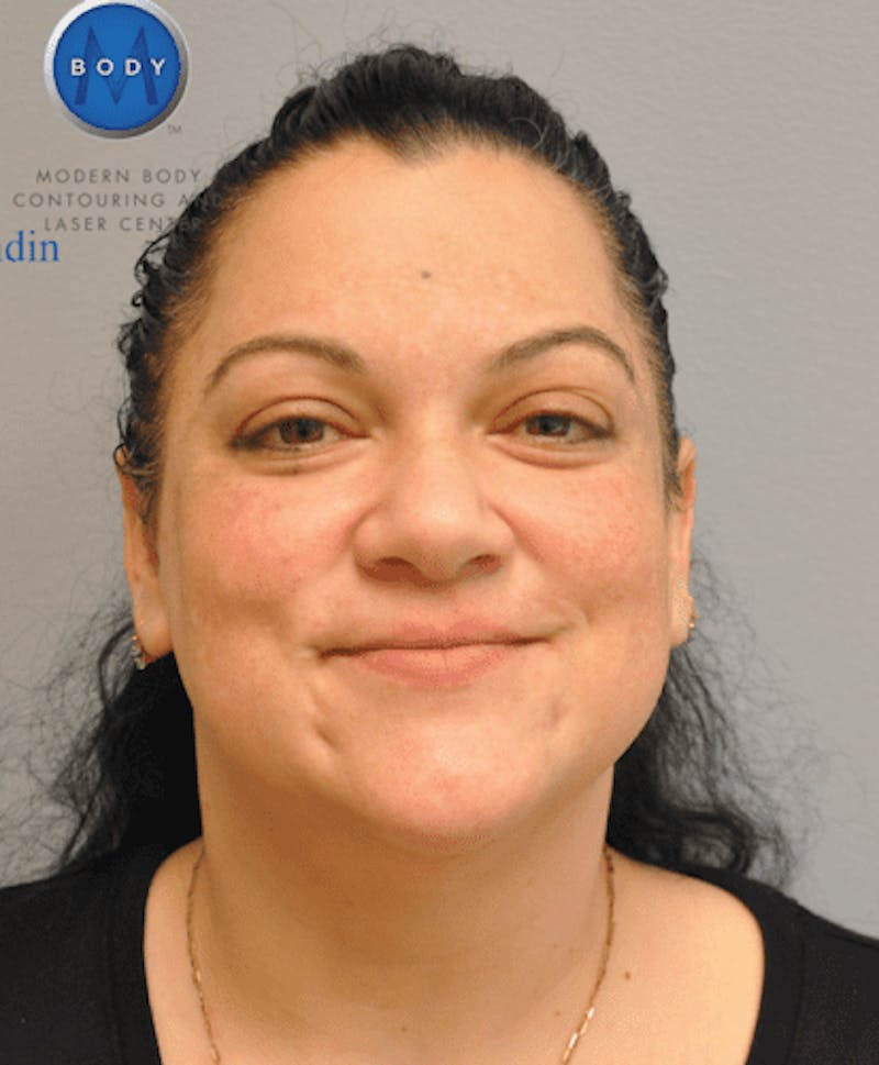 Liposuction Before & After Gallery - Patient 55345375 - Image 2