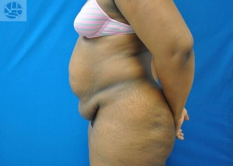 Tummy Tuck Before & After Gallery - Patient 55345373 - Image 7