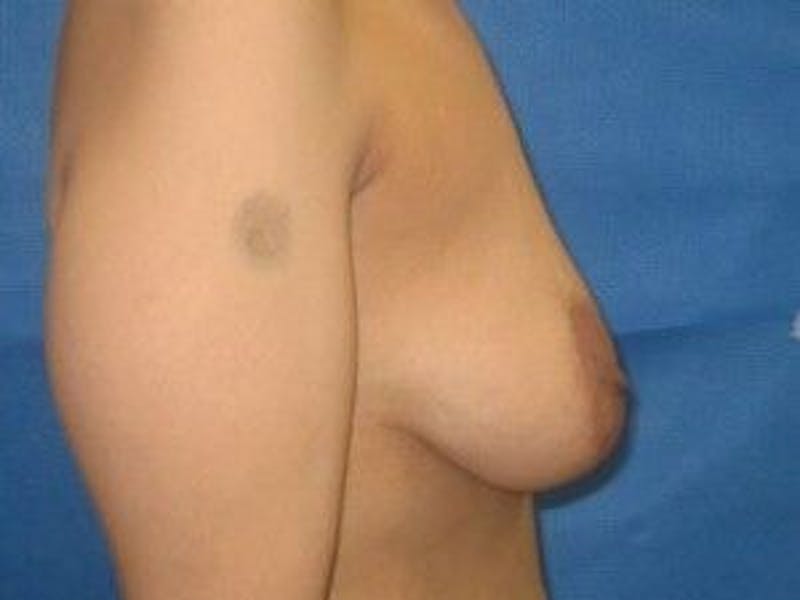 Breast Lift Gallery - Patient 55345374 - Image 3