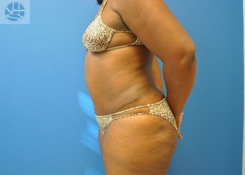 Plus Size Tummy Tuck Before & After Gallery - Patient 702087 - Image 8