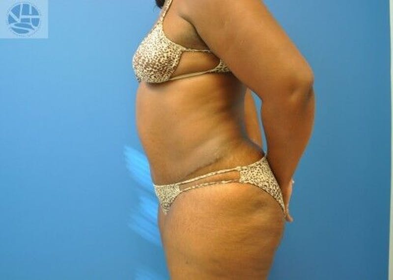 Tummy Tuck Before & After Gallery - Patient 55345373 - Image 8