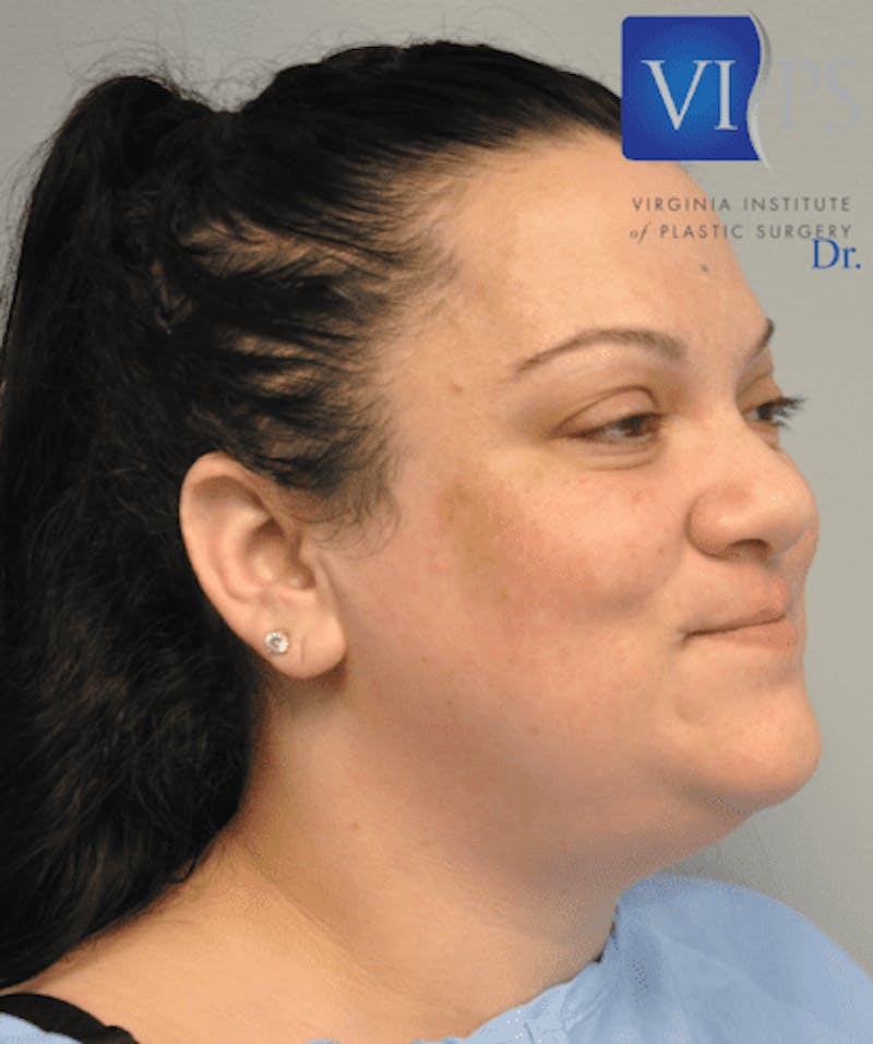 Liposuction Before & After Gallery - Patient 55345375 - Image 3