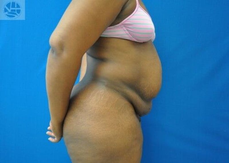 Tummy Tuck Before & After Gallery - Patient 55345373 - Image 9