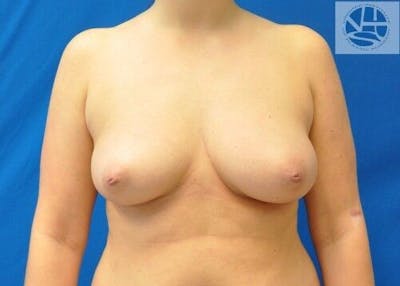 Breast Augmentation Before & After Gallery - Patient 55345377 - Image 1