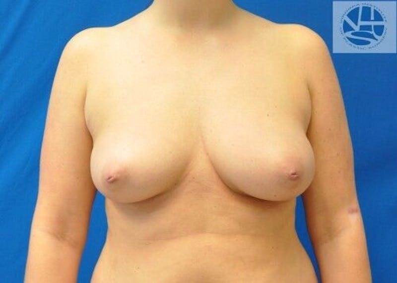 Breast Augmentation Before & After Gallery - Patient 55345377 - Image 1